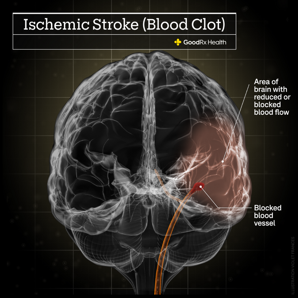 Brain, Stroke, Paralysis, and Neurological Disease Specialist